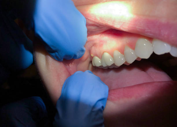 Best Emergency Gum Treatment in Doa Ana, NM